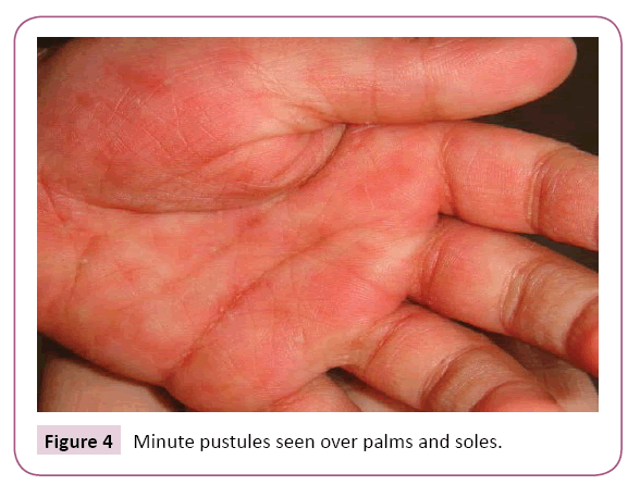 exfoliative dermatitis คือ pics