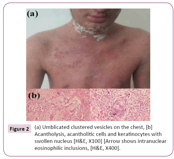 A Case Of Eczema Herpeticum Occurring On The Lesions Of Pemphigus Foliaceus Insight Medical Publishing
